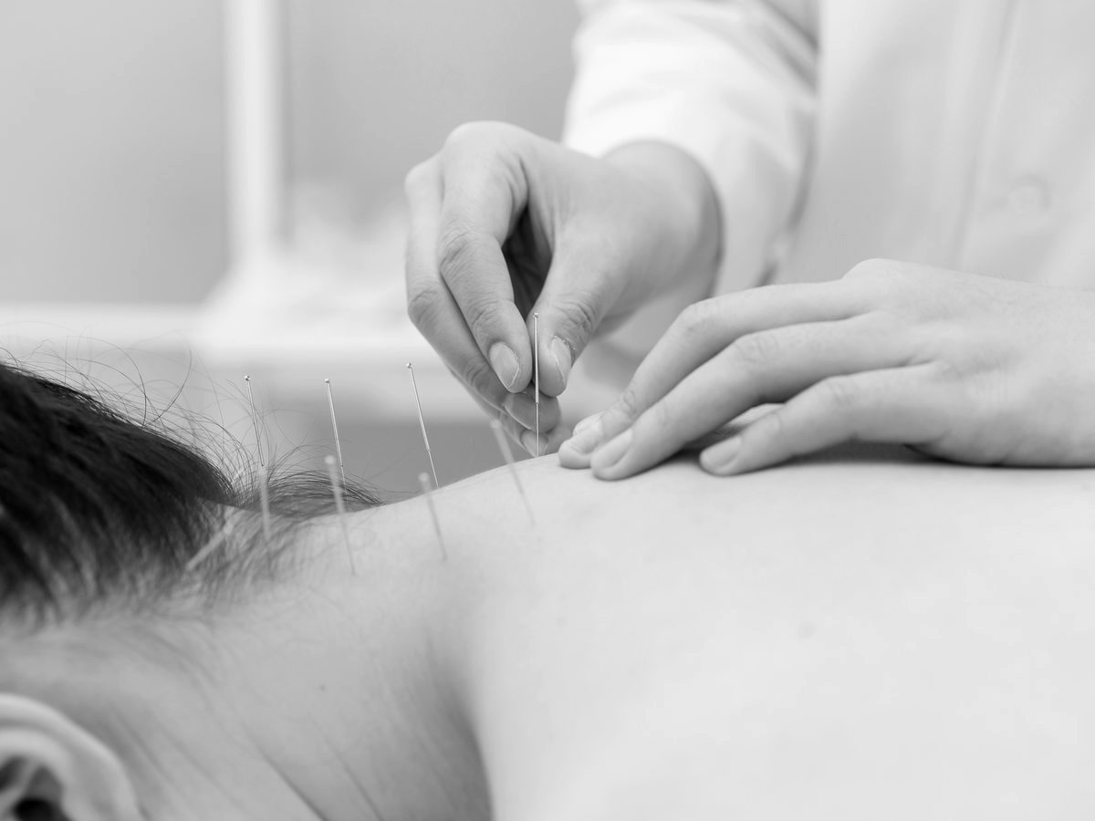 Akupunkturbehandlung in der Schmerztherapie